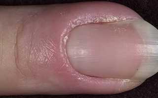 Панариций. причины, симптомы, лечение заболевания. панариций подногтевой, пальцев рук и ног