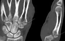 Мрт кисти рук и лучезапястного сустава: что показывает, техника проведения