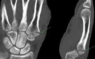 Мрт кисти рук и лучезапястного сустава: что показывает, техника проведения