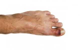 Как отличить ушиб от перелома