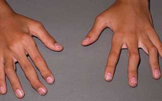 Почему возникают боли в суставах пальцев рук и как их лечить?