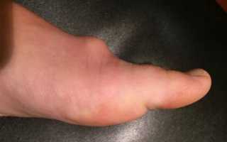 Под кожей появилось уплотнение в виде шарика: что это может быть?