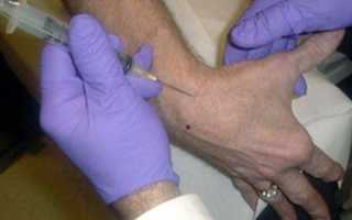 Что делать, если не сгибаются пальцы рук