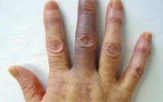 Посинел палец на руке: возможные причины и лечение