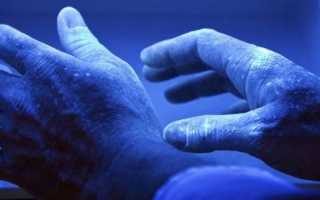 Грибок ногтей и кожи рук: причины появления, лечение