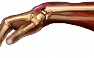 Перелом лучезапястного сустава. как быстрее вернуть себе трудоспособность?