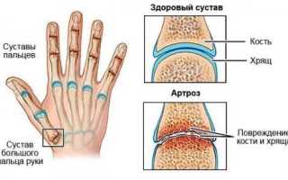 Хрустят кисти рук у ребенка