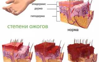 Лечение ожога кипятком в домашних условиях