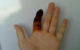 Что делать при нарыве пальца?