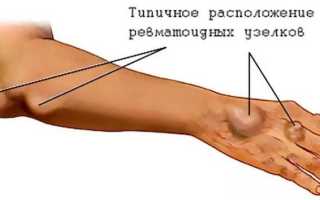 Отекают руки. причина отеков, диагностика, лечение отеков рук