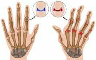 Щелкающий палец (синдром щелкающего пальца; стенозирующий тендовагинит; стенозирующий лигаментит; защелкивающийся, пружинящий, рессорный палец; болезнь нотта; узловатый тендинит)