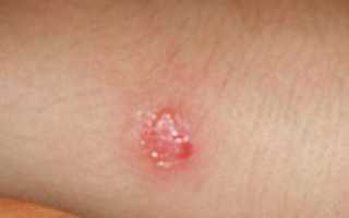 Болячки на пальцах рук фото