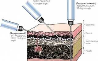 Как правильно и куда делают прививку от гриппа детям и взрослым (инструкция по технике постановки укола)