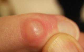 Опухоль на руке как признак онкологии. гигрома на пальце руки