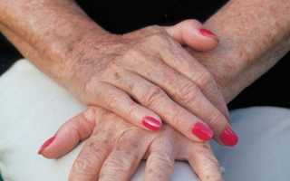 Способы избавления от возрастной пигментации на руках