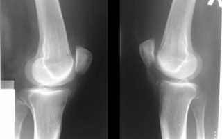 Болит сустав указательного пальца от мышки