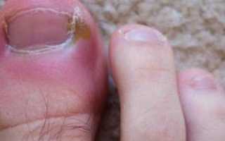 Почему посинел палец на ноге