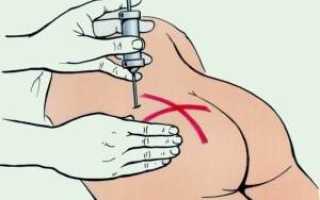 Как сделать подкожную инъекцию самому себе?