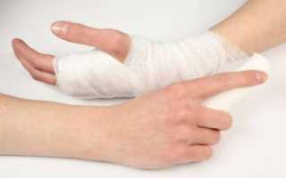 Что делать, если после снятия гипса с руки появляется отечность и сильная боль