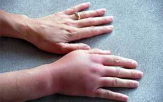 Почему у вас распухли руки и пальцы при ходьбе? – ходьба – 2020