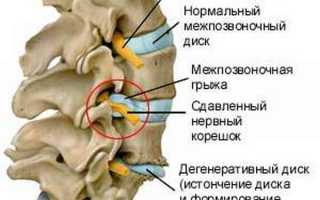 Слабость в руке