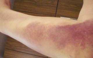 Разновидности, симптоматика, лечение, реабилитация переломов лучезапястного сустава