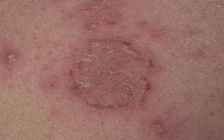 Что может означать покраснение кожи на руках