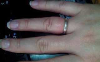 Шишки на суставах пальцев рук: причины, диагностика и лечение