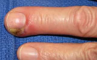 Подногтевой панариций: лечение воспаления