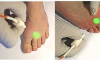 Методы быстрого избавления от мозоли на пальце руки