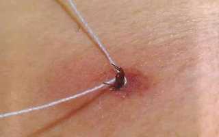 Почему немеют пальцы: указательный, большой, средний